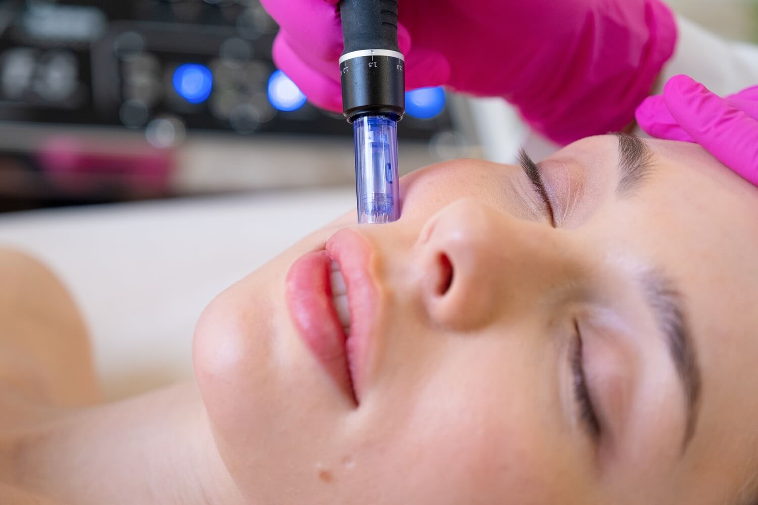 Микронидлинг процедура от козметично студио EDEN beauty and care във Варна Микронидлинг процедура от козметично студио EDEN beauty and care във Варна